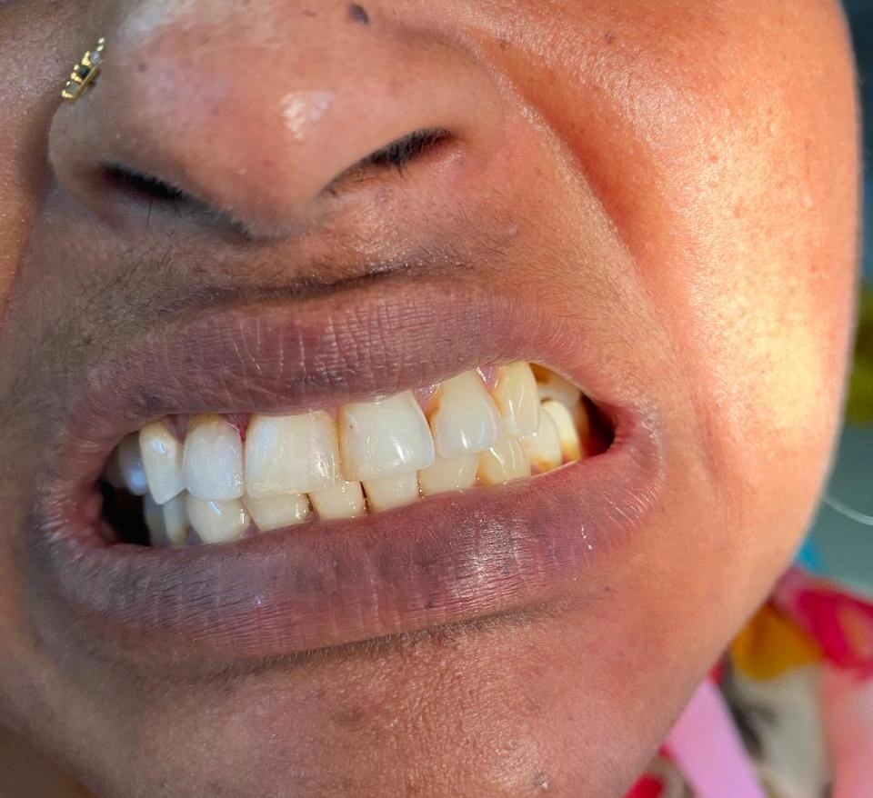 Close-up of a woman's smile after tooth recontouring, showing smoothed dental edges and corrected tooth shapes
