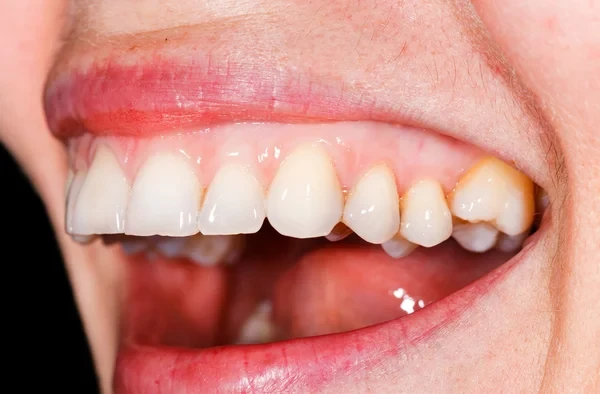 Close-up of healthy upper teeth and gums showcasing a beautiful, natural smile.