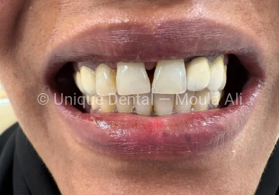 Close-up photo of a patient after the procedure at Unique Dental during fixed dental prosthetic treatment. 17-Unit Full Mouth Bridge – A Complete Smile Transformation