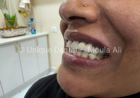 Close-up photo of a patient after the procedure at Unique Dental during fixed dental prosthetic treatment. 17-Unit Full Mouth Bridge – A Complete Smile Transformation