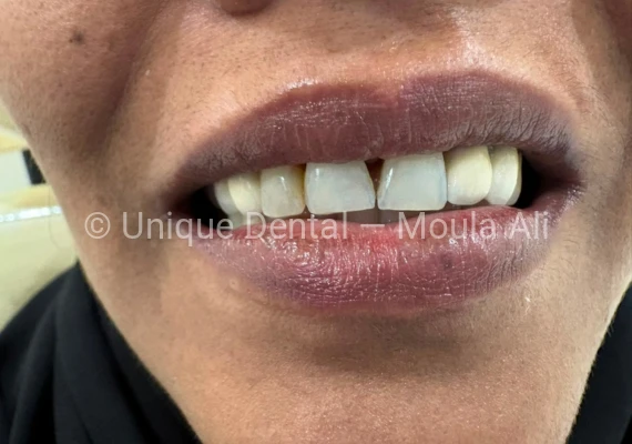 Close-up photo of a patient after the procedure at Unique Dental during fixed dental prosthetic treatment. 17-Unit Full Mouth Bridge – A Complete Smile Transformation