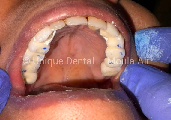 Close-up photo of a patient after the procedure at Unique Dental during fixed dental prosthetic treatment. 17-Unit Full Mouth Bridge – A Complete Smile Transformation