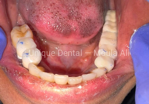 Close-up photo of a patient after the procedure at Unique Dental during fixed dental prosthetic treatment. 17-Unit Full Mouth Bridge – A Complete Smile Transformation