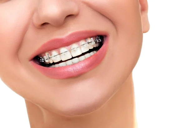 Closeup Beautiful Female Smile with Transparent Ceramic and Metal Braces on Teeth. Orthodontic Treatment