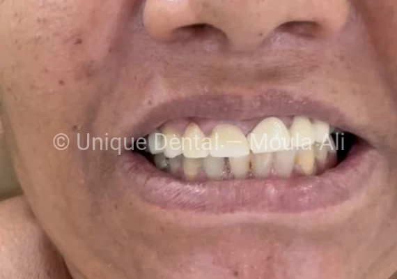 Closeup mouth photo of a patient after the RCT procedure is done