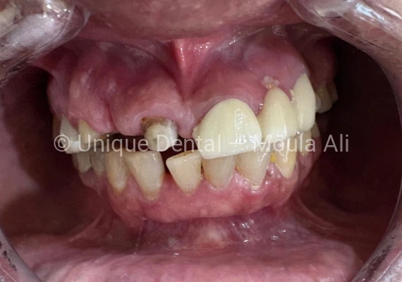 Closeup mouth photo of a patient during the procedure, done RCT and Post and Core