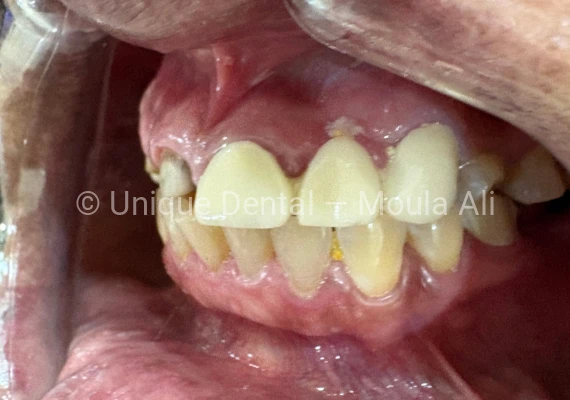Closeup mouth photo of a patient during the procedure, done RCT and Post and Core