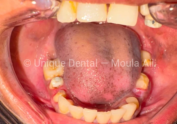 Closeup photo of a patient during the procedure at Unique Dental during fixed dental prosthetic treatment. 17-Unit Full Mouth Bridge – A Complete Smile Transformation