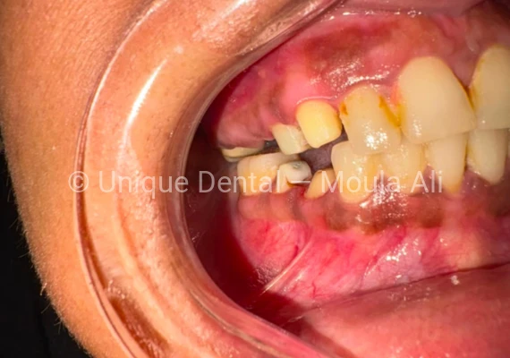 Closeup photo of a patient during the procedure at Unique Dental during fixed dental prosthetic treatment. 17-Unit Full Mouth Bridge – A Complete Smile Transformation