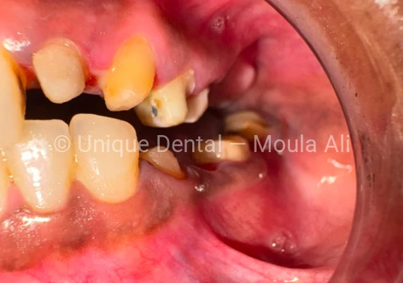 Closeup photo of a patient during the procedure at Unique Dental during fixed dental prosthetic treatment. 17-Unit Full Mouth Bridge – A Complete Smile Transformation