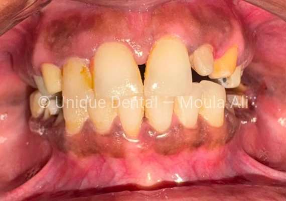 Closeup photo of a patient during the procedure at Unique Dental during fixed dental prosthetic treatment. 17-Unit Full Mouth Bridge – A Complete Smile Transformation