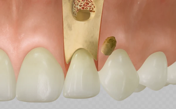 Cross-section illustration showing root-end resection surgery on a maxillary incisor tooth.