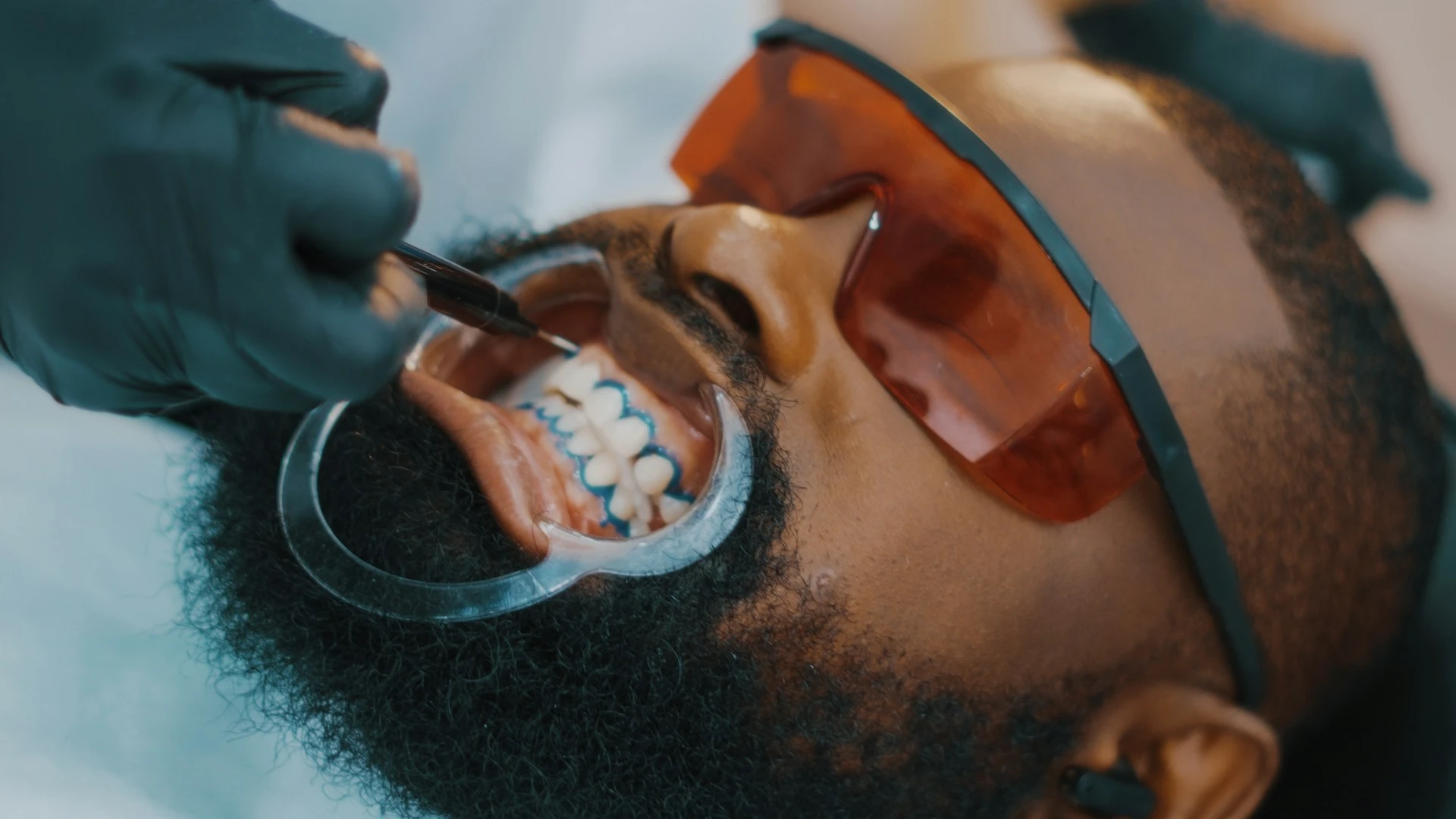 Deep teeth cleaning