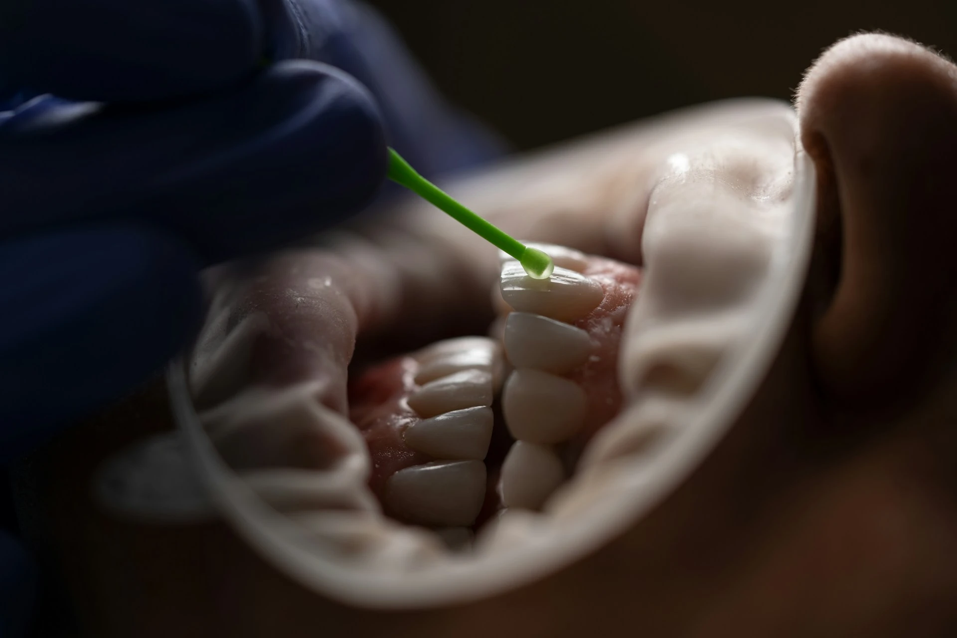 Dental Fluoride Treatment