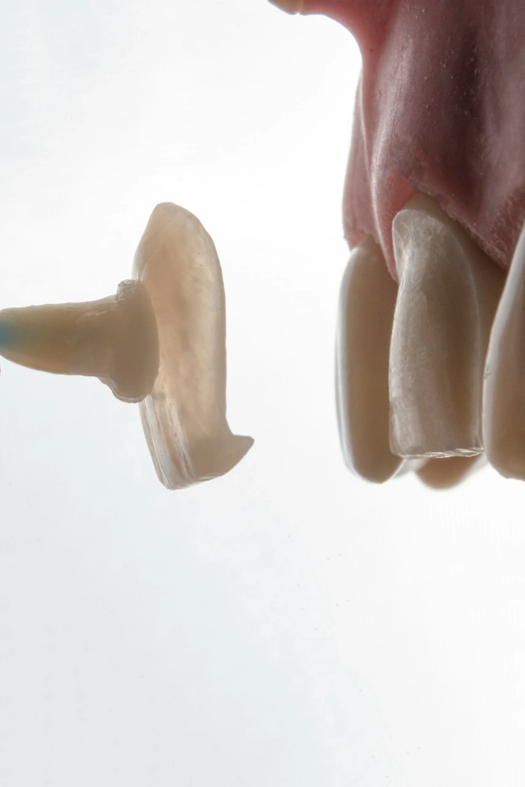 Dental Veneers