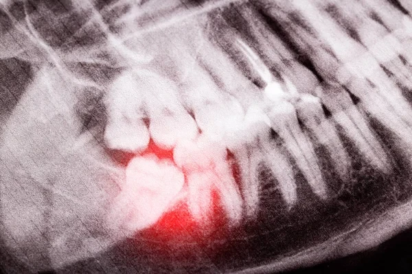 Dental X-ray showing an impacted wisdom tooth pressing against adjacent molars.