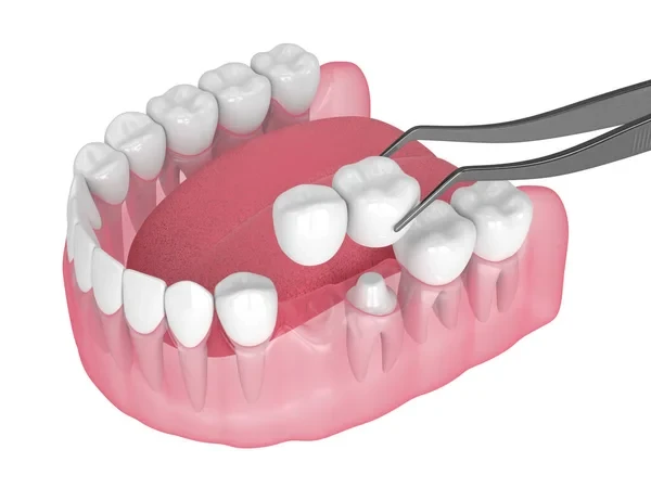 3D rendering of a dental bridge being placed over a prepared tooth to replace a missing molar in the lower jaw