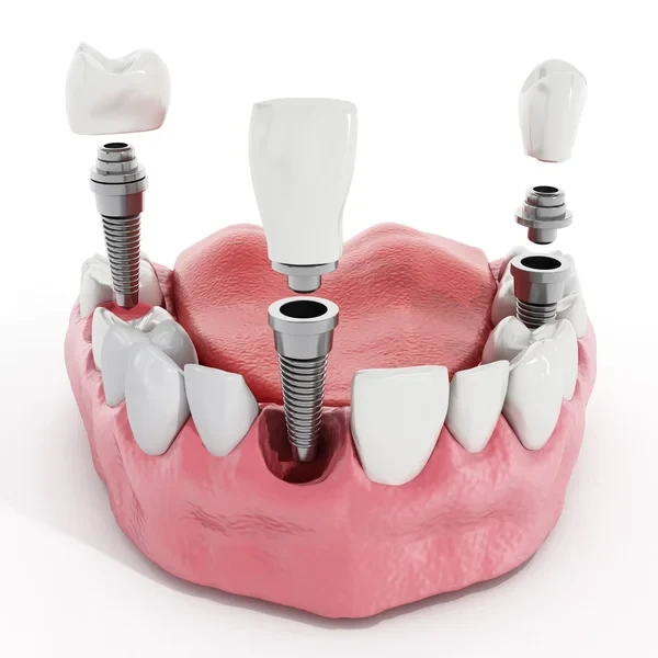 3D model of a lower jaw illustrating the components of a dental implant restoration, including the titanium post, abutment, and ceramic crown