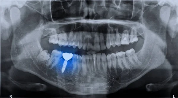 Dental panoramic radiograph with a blue highlight illustrating a successful tooth implant restoration.