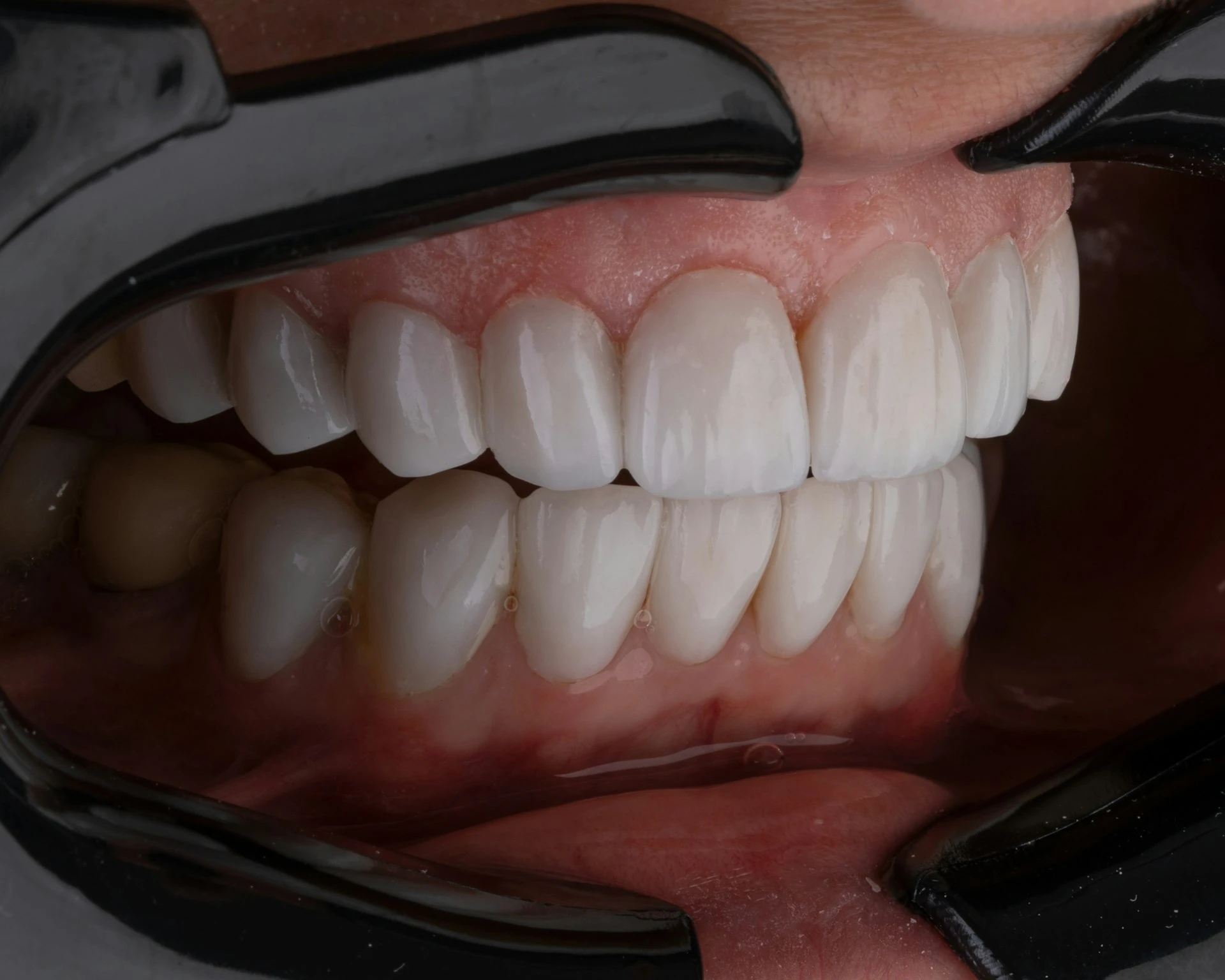 The dentist is examining the teeth and jaw alignment after the dental procedure.