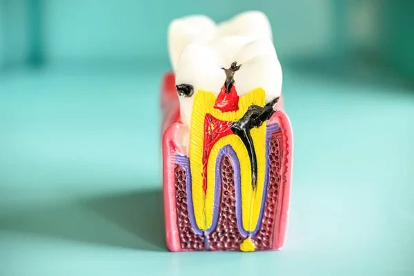 Detailed dental model illustrating caries extending through enamel and dentin into the pulp
