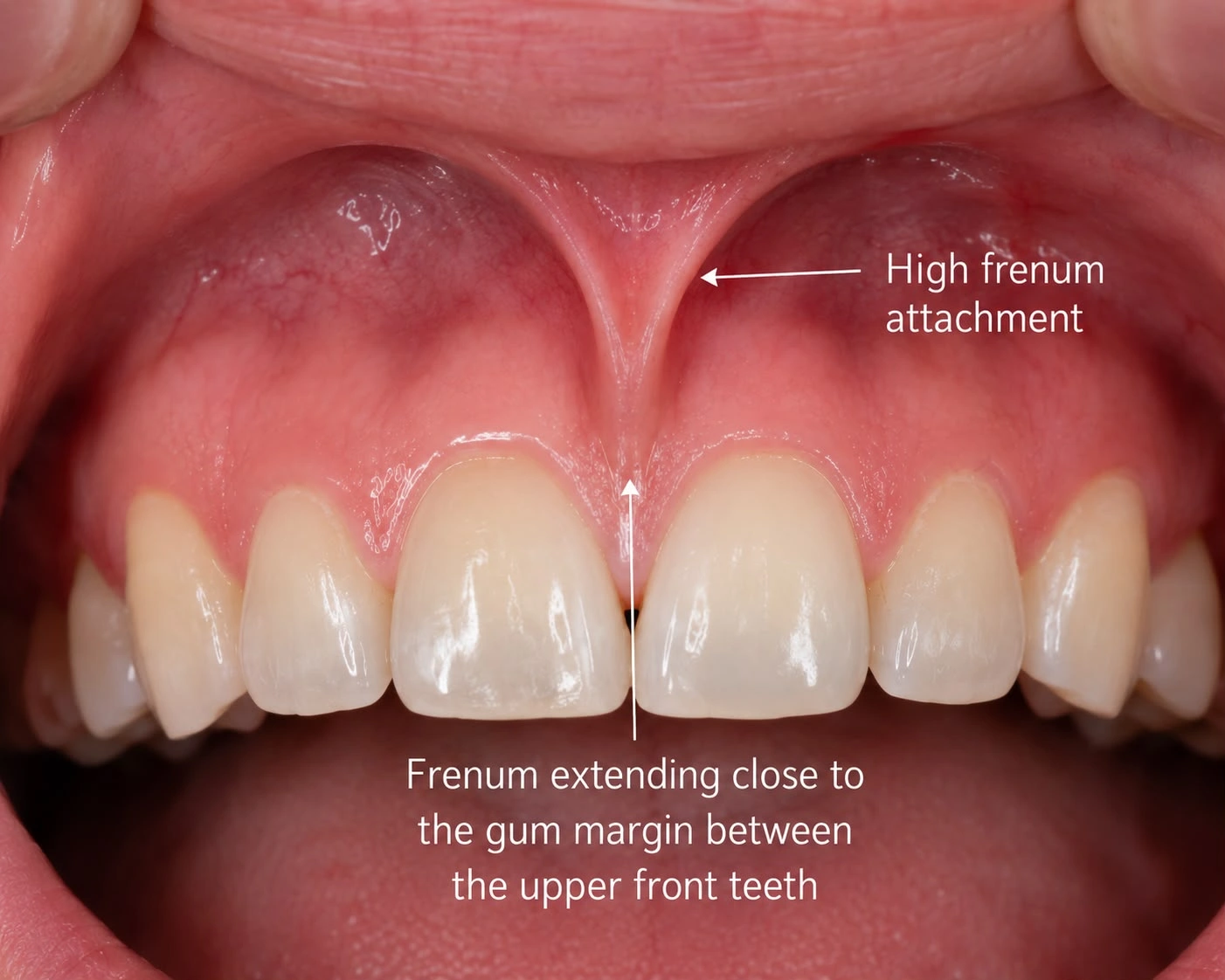 Clinical diagram of a high maxillary labial frenum attachment, with arrows indicating the thick tissue fold extending close to the gum margin between the two upper front central incisors.