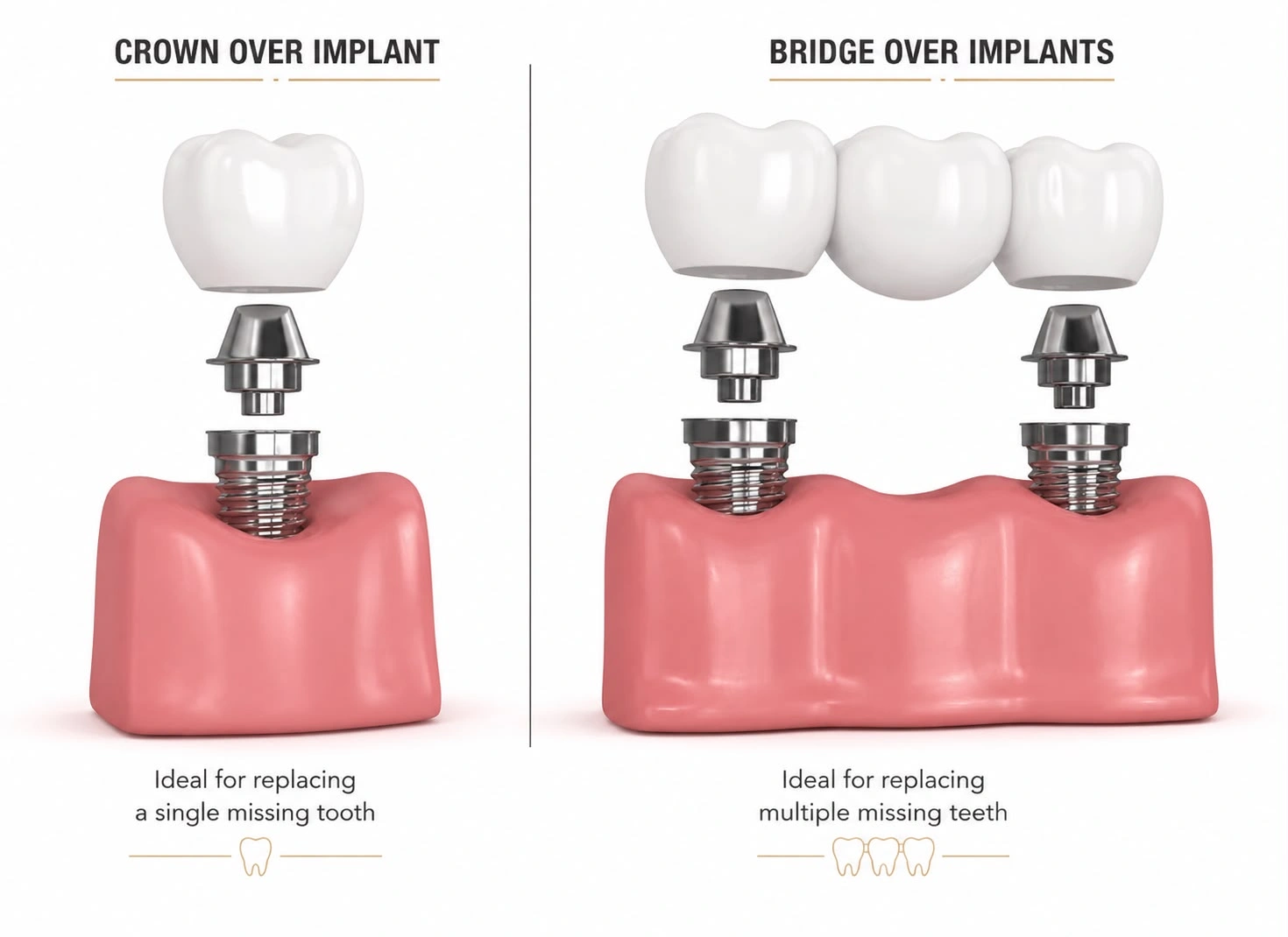 Diagram showing the structural difference between a single dental implant crown and an implant-supported dental bridge.