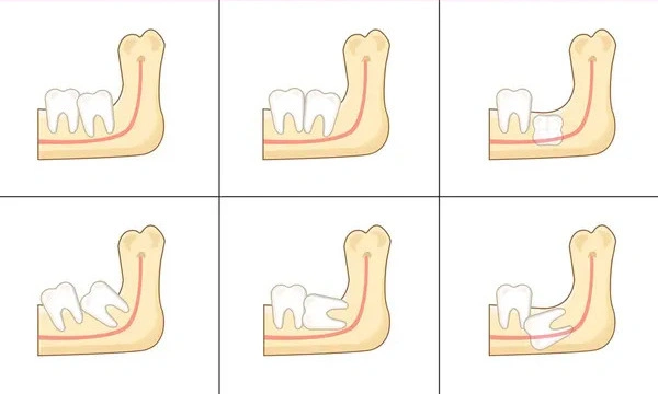 Educational dental infographic showing six different types of wisdom teeth problems, including normal eruption, partial eruption, horizontal impaction, and vertical impaction in the jaw