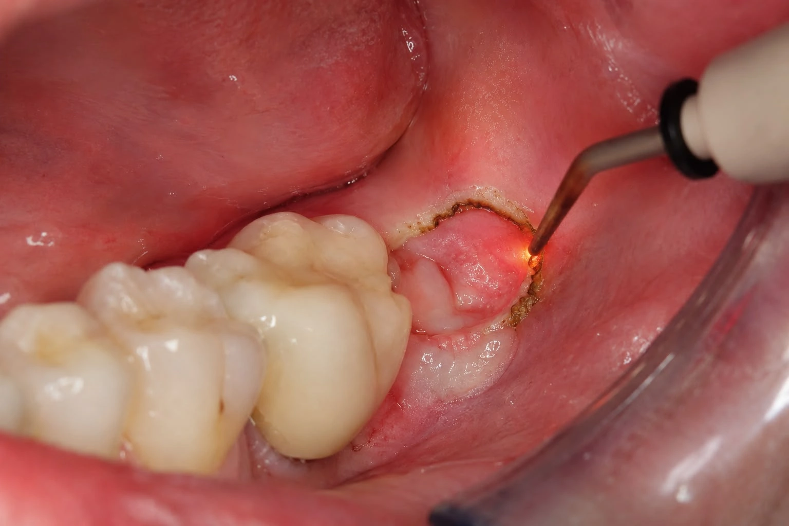 Close-up intraoral view of an electrocautery handpiece tip surgically excising an inflamed gum tissue flap or operculum from the crown of a partially erupted lower wisdom tooth.