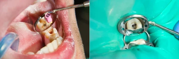 Endodontic treatment teeth close cleaning