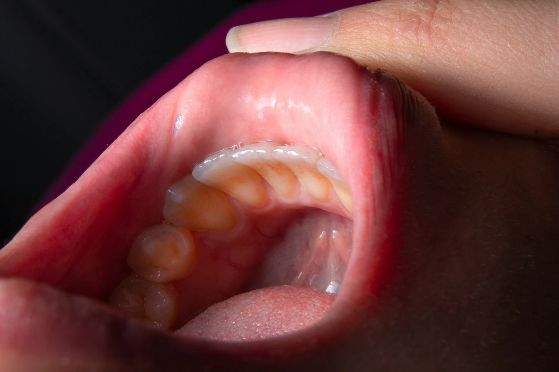 Full Mouth Examination