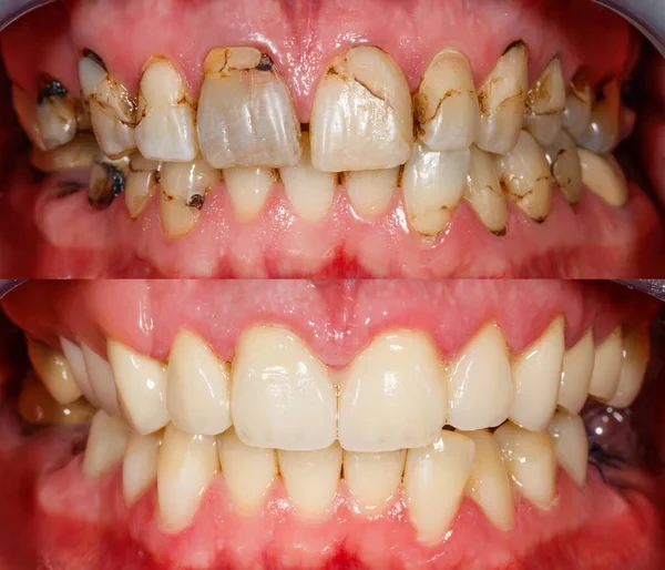 Full mouth rehabilitation