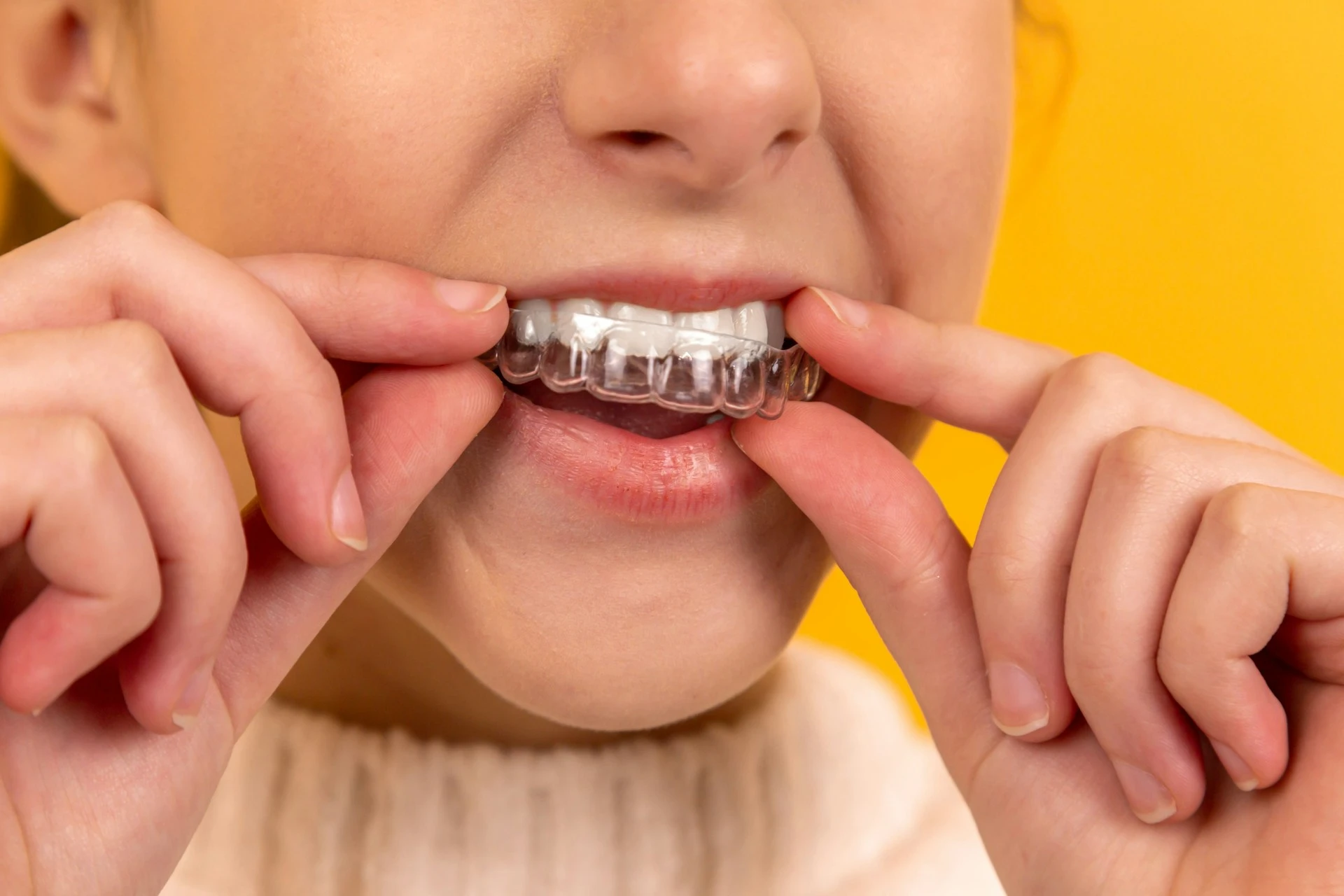 Girl putting on a clear Invisalign orthodontic aligner.