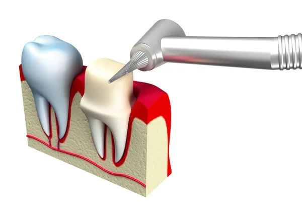 Graphic image showcasing the preparation of the tooth for a dental crown