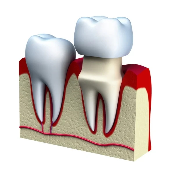 Graphic image showing a dental crown installation on a tooth