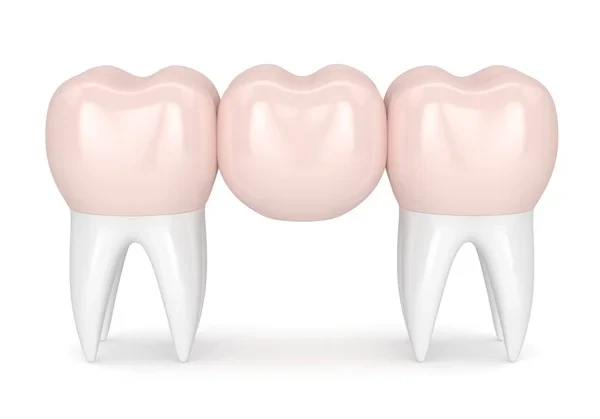 Graphic of dental bridge