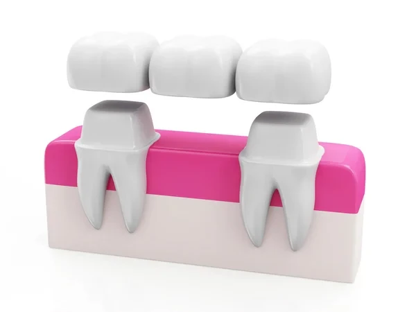 Graphics of a dental bridge concept