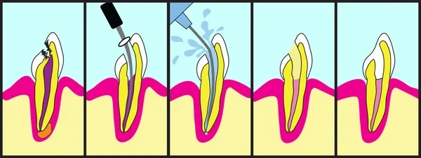 Graphics of a root canal treatment process.