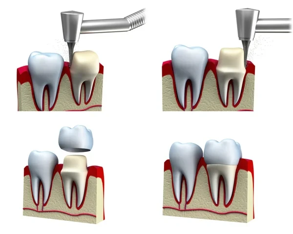 Graphics of dental crown installation process