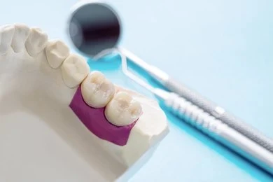 Gypsum dental model used for fabricating custom crowns and tooth restorations.