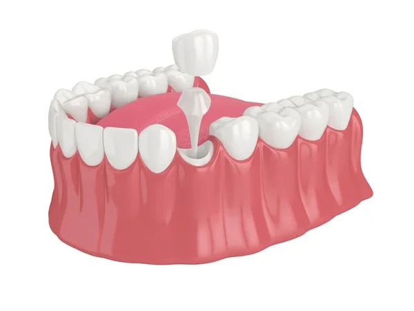 Illustration of a lower jaw showing a post and core tooth restoration.