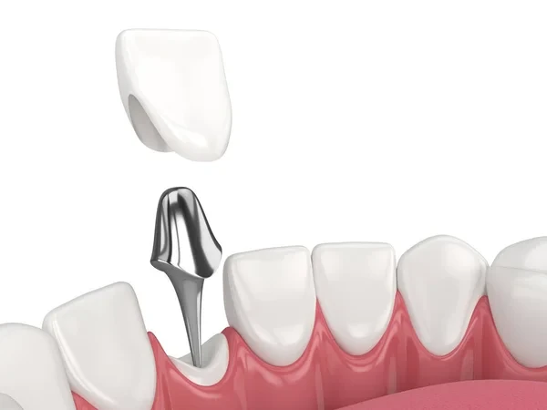 Illustration of a lower jaw with a cast post and core tooth restoration.