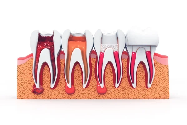 Illustration of the stages of root canal treatment