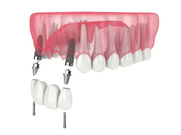 Medical illustration detailing an implant bridge restoration structure next to natural teeth roots.