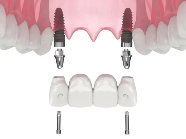 Medical illustration detailing the components of an implant-supported dental bridge restoration.