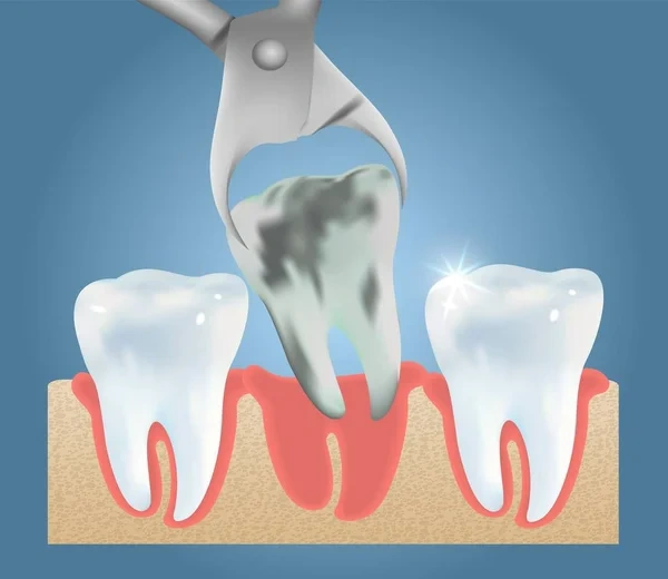 Medical vector illustration showing a severely decayed tooth being removed from the lower jaw using dental extraction forceps