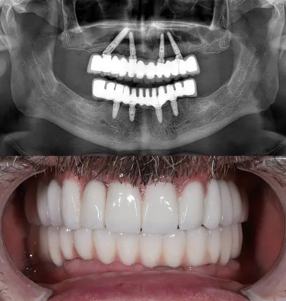 Panoramic dental X-ray showing full-arch implants in the upper and lower jaws (top) and the final aesthetic porcelain dental prosthesis in the patient's mouth (bottom).