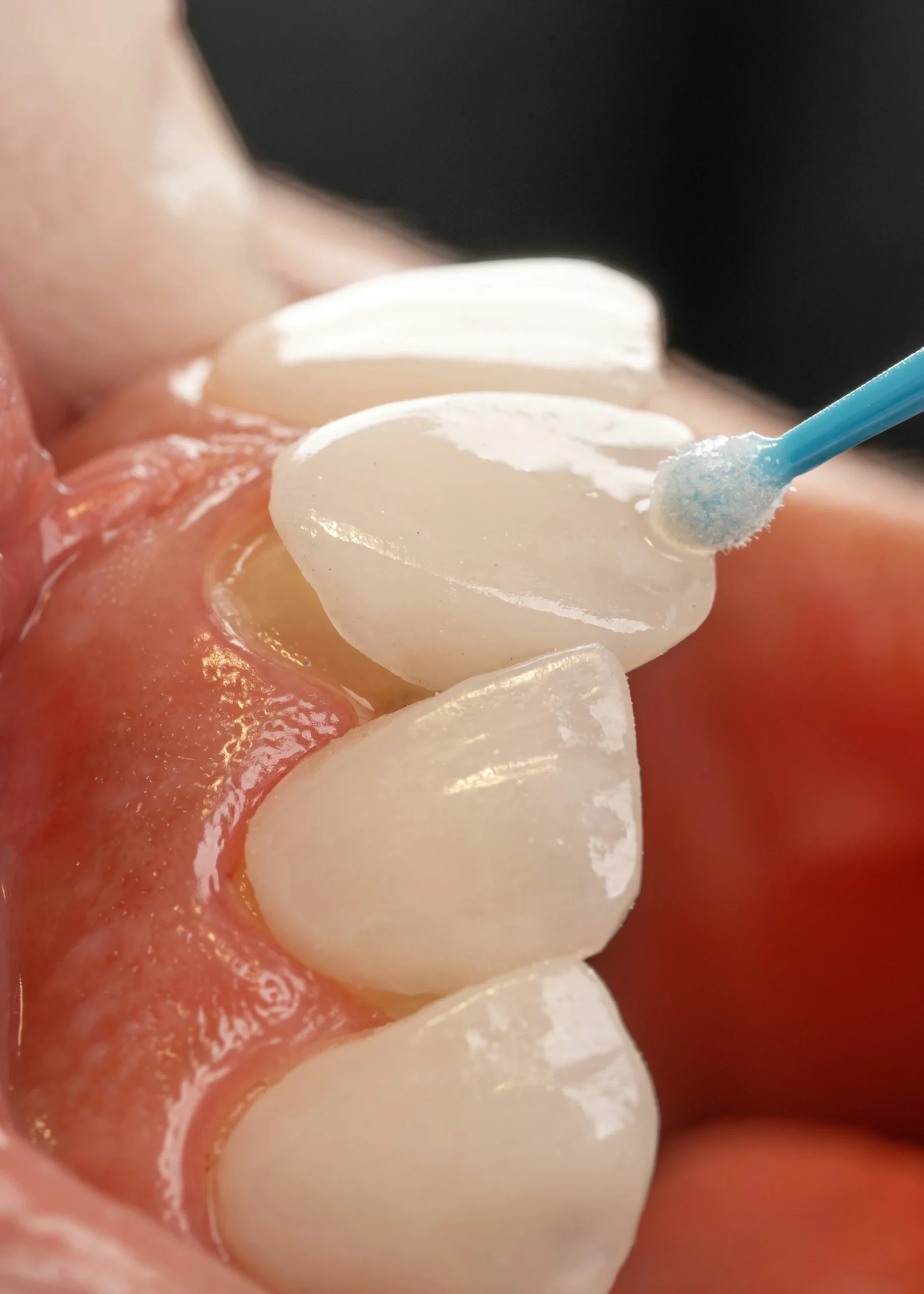 Placing dental veneers over natural teeth