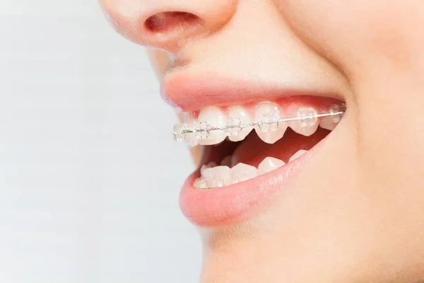 Side profile view of a woman's smile showcasing clear ceramic braces on her upper teeth
