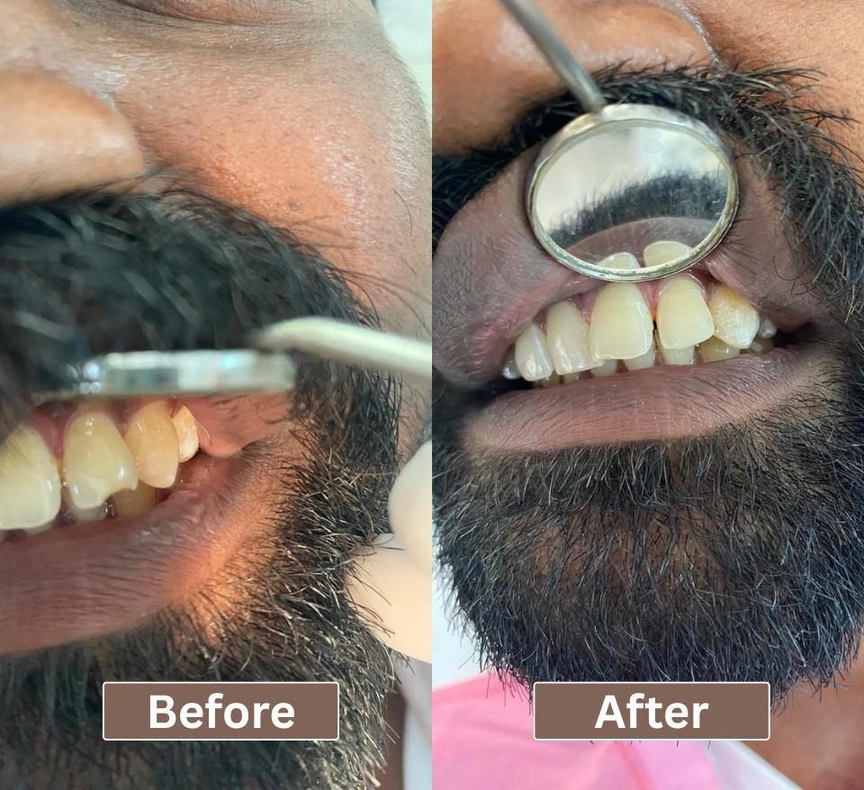 Split screen showing a man's upper teeth before and after tooth recontouring, highlighting the smoothing of a sharp, uneven front tooth